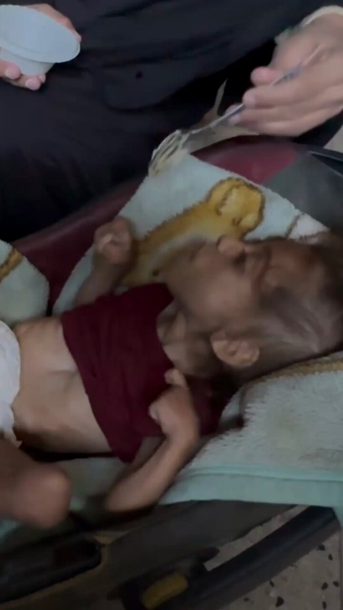 Gazze'de Zor Koşullarda Tedavi Bekleyen Küçük Misk'in Hikayesi